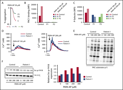 Figure 4. Downregulation of platelet signaling induced by PAR4-AP. (A) Aggregation of washed platelets for P1 and P2 was initiated by PAR4-AP (50 μM) for 3 minutes. Aggregation was expressed as the percentage change in light transmission, with the value of the blank (buffer without platelets) set at 100%. Tracings are representative of at least 2 experiments per patient. (B) Quantification of activated αIIbβ3 at the surface of washed platelets was assessed by flow cytometry by binding of the specific mAb PAC1 to control, P1, and P2 platelets upon activation by PAR4-AP (100 to 200 μM). (C) Quantification of P-selectin expression at the surface of washed platelets was assessed by flow cytometry by binding of the specific anti-P-selectin antibody to control, P1, and P2 platelets upon activation by PAR4-AP (100 to 200 μM). These results are representative of 2 experiments for each patient. (D) Ca2+ mobilization was assessed in unstirred platelets preincubated with the cytosolic Ca2+ fluorescent probe Oregon green BAPTA-AM after stimulation by PAR4-AP (100 and 200 μM) by flow cytometry in conditions of no external Ca2+ (1mM EGTA). (E-F) Phosphorylation of PKC substrates and Src-Y418 of control and P1 platelets activated by PAR4-AP (0 to 300 µM) was assessed by immunoblotting using an anti-PKC substrates (p-S) and anti-Src-p-Y418, respectively. Results are representative of 2 experiments. Quantification of Src phosphorylation (Src-p-Y418) was the average of the 2 experiments.