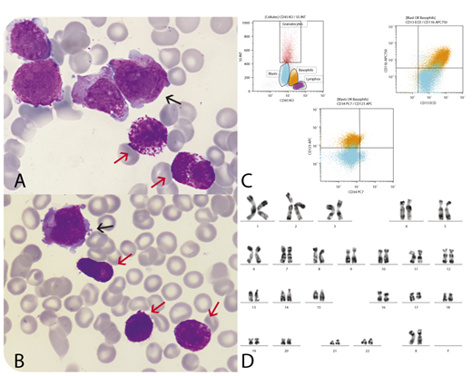 A 59-year-old woman was hospitalized for investigation of spontaneous bruises on arms and legs and asthenia. Complete blood count and blood smear review showed pancytopenia (platelets 78 × 109/L, hemoglobin concentration 10.6 g/dL, leukocytes 1.8 × 109/L) with 10% blast cells and 13% basophils (0.2 × 109/L). Coagulation tests, including fibrinogen and D-dimers, were normal. Bone marrow examination showed 64% hypergranular blasts with Auer rods (panels A and B, black arrows; original magnification ×100, May-Grünwald Giemsa stain), typical of acute promyelocytic leukemia (APL) and 13% basophils with abnormal features: hypergranularity and abnormal granular repartition (red arrows). Flow cytometry (panel C) confirmed a typical profile of promyelocytic cells (cMPO+, CD34−, HLA DR−, CD117+, CD33+, CD13+, CD123−) and basophils (CD11b+, CD25+, CD123+, CD13+, CD33+, CD44+) with an abnormal immunophenotypic profile (CD38−, CD117low). Cytogenetic analysis (panel D) revealed t(15;17)(q24;q21), and molecular analysis showed classical PML-RARA transcript. Classical APL treatment was given. Basophilia increased to 0.39 ×109/L at day 19 and normalized by day 24. The patient has started her first consolidation without problems. / Basophilia at diagnosis of APL is very uncommon. This case highlights that basophilia can be associated with an APL clone. Basophilia at presentation of APL has been reported and said to have an increased risk of bleeding, not seen in this patient.