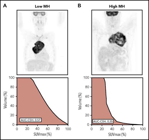Figure 1. Examples of the various degrees of MH in primary mediastinal B-cell lymphoma. (A) PET imaging and the corresponding CSH histogram in a patients with low heterogeneity (AUC-CSH, 0.57). (B) PET imaging and the corresponding CSH histogram in a patient with high heterogeneity (AUC-CSH, 0.35). Lower AUC-CSH values correspond to higher metabolic heterogeneity.