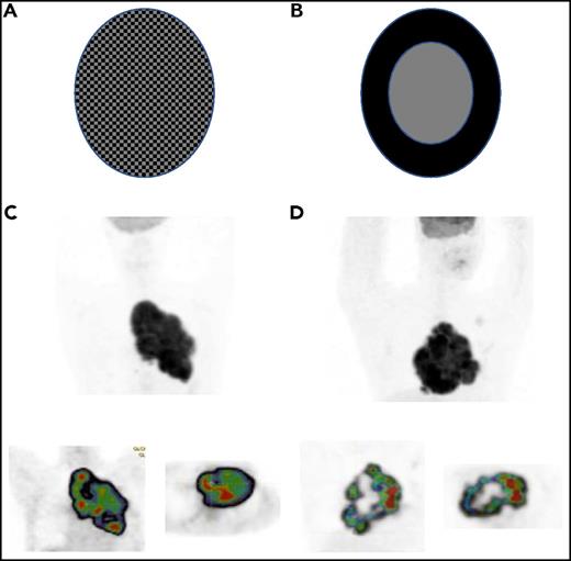 (A-B) Schematic distributions of SUV in 2 tumor volumes. Illustration courtesy of Irene Buvat, Unité d’Imagerie Moléculaire in Vivo, UMR1023 INSERM CEA, Orsay, France. (C-D) Two patients with PMBCL (NCT00498043 trial): (upper) maximum intensity projection image and (lower) cartography of the regional homogeneity indices (decreasing from red to blue) on (lower left) coronal and (lower right) transverse slice7; data from patient C: COV, 0.17; spatial homogeneity, 0.45, and patient D: COV, 0.17, spatial homogeneity, 0.28. Illustration processed with LIFEX software, www.lifexsoft.org/.