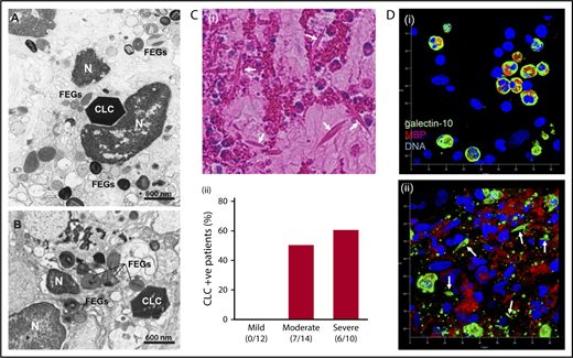 Figure 1. CLCs are associated with EETosis in human tissues. (A-B) Tissue CLCs in biopsies of frontal sinus (A, allergic patient) and bacterially infected colon (B, ulcerative colitis) with a large number of FEGs released by infiltrating lytic eosinophils. Note hexagonal crystals and chromatolytic nuclei (N). Samples were prepared for conventional TEM. (C) Evaluation of CLCs in nasal polyps from ECRS patients. (i) Arrows indicate typical CLCs (40× objective). Note the abundant eosinophils with chromatolysis and FEGs. (ii) The percentage of CLC-positive patients was assessed by hematoxylin and eosin staining according to clinical severities. Assessment of CLCs and detailed study subject information are provided in the supplemental materials. Numbers represent CLC-positive patients/total patients in each group. (D) Maximal projection of 3-dimensional z-stack images of galectin-10 (green) and MBP (red) staining of nasal polyps from ECRS patients. (i) A region of lesser eosinophil infiltration exhibiting intact eosinophils; (ii) a highly inflamed lesion with abundant CLCs. In panel Di, eosinophils with bilobed nuclei (blue) showed cytoplasmic/perinuclear galectin-10 staining. In contrast, small punctate galectin-10 and loss of cytoplasmic CLC with extracellular MBP were observed in panel Dii. CLCs with a bipyramidal structure (arrows) were stained with galectin-10. Images were obtained with a Carl Zeiss LSM780 confocal microscope (100× objective). The scale shows each 10 µm.