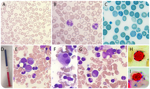 An 83-year old white man with microcytic anemia (hemoglobin 119 g/L; mean corpuscular volume 69 fL) and thrombocytopenia (120 × 109/L) had prominent red cell changes (microcytosis, target cells, elliptocytes, schistocytes) (panel A; original magnification ×40, Wright Giemsa stain), and ∼80% neutrophils were hypogranular and/or abnormally segmented (panel B; original magnification ×40, Wright Giemsa stain) on blood film. Hemoglobin electrophoresis and high-performance liquid chromatography were normal. Approximately 5% red cells showed hemoglobin H (HbH) inclusion bodies (panel C; original magnification ×100, brilliant cresyl blue stain). The i+LABORATORY α-thalassemia immunochromatographic strip test was positive (panel D), consistent with α-thalassemia. The patient lacked family history of thalassemia, had previous normal presentation (no jaundice/splenomegaly), normal red blood cell parameters, and granulocyte morphology. This led to clinical suspicion of acquired HbH disease associated with myelodysplastic syndromes (MDS). Bone marrow showed trilineage dysplasia–multinucleated erythroids (panel E; original magnification ×40, Wright Giemsa stain), hypolobate megakaryocytes (panel F, ×40), and hypogranular granulocytes (panel G, ×40). Ringed sideroblasts (23%) were noted (panels H-I; original magnification ×100, potassium hexacyanoferrate with neutral red counterstain). MDS with ringed sideroblasts and multilineage dysplasia was diagnosed. Cytogenetic analysis showed +14. / α-Thalassemia is an autosomal recessive inherited disorder of red blood cells. It can also occur as an acquired defect in disorders associated with ineffective erythropoiesis, especially MDS. Acquired α-thalassemia is due to acquired somatic mutations in the ATRX gene (Xq21.1), resulting in downregulation of α-globin gene expression.