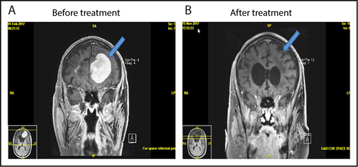 Figure 3. MRI of brain showing CR of relapsed PCNSL to the study treatment. This patient with relapsed PCNSL (A) achieved CR after cycle 8 (B). He achieved PR after cycle 4. This case corresponds to patient 21 in Figure 2.