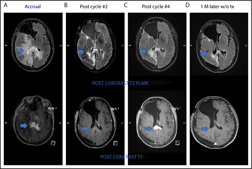 Figure 4. Pseudoprogression in a PCNSL patient treated with pomalidomide. (A-B) The patient had stable disease after cycle 2 and (C) showed radiologic findings suggestive of progression of disease on restaging MRI of brain after cycle 4 without clinical deterioration. She was taken off study as per protocol. (D) Repeat MRI of brain 1 month later without any steroid or any other treatment showed radiologic improvement. This case is the patient 11 on Figure 2.