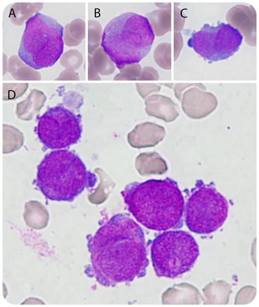 A 94-year-old man presented with hemoptysis, hematuria, and weight loss. A blood count showed pancytopenia (hemoglobin 7.5 g/dL, neutrophils 0.15 × 109/L, platelets 25 × 109/L). The peripheral smear (original magnification ×1000; May-Grünwald-Giemsa stain) showed 40% promyelocytes with distinct bilobed nuclei and sparse, fine azurophilic granules (panels A-C). Occasional promyelocytes with cytoplasmic projections (panel C) were seen. Bone marrow smears showed 55% promyelocytes with deep cytoplasmic basophilia and prominent cytoplasmic projections resembling micromegakaryocytes (panel D). Auer rods were absent. There was mild nuclear-cytoplasmic asynchrony of erythroblasts, without other dysplastic changes. Flow cytometry showed an abnormal immature myeloid population with phenotype CD34− CD33+ CD117+ MPO+ HLA-DR weak. Based on these findings, the patient was commenced on chemotherapy-free induction with tretinoin and arsenic trioxide for acute promyelocytic leukemia (APL). Subsequently, fluorescence in situ hybridization of the bone marrow aspirate confirmed PML-RARA fusion, and a t(15;17) translocation was detected by karyotyping. Molecular tests revealed a FLT3-ITD mutation. The patient achieved complete remission at 28 days postinduction and proceeded to consolidation therapy. / This case illustrates the rare microgranular hyperbasophilic variant of APL with cytoplasmic projections resembling micromegakaryocytes. Promyelocytes with cytoplasmic projections have been described in both hypergranular and microgranular forms of APL. Recognition of this variant is important for the morphological diagnosis of APL.