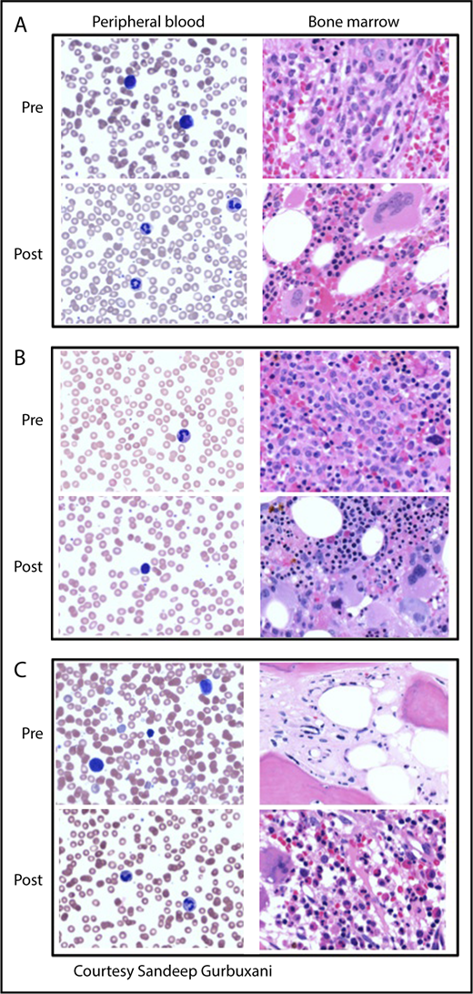 Figure 2. Peripheral blood smears and bone marrow biopsies pre- and posttherapy of MPN-BP. (A) IDH2-mutated MPN-BP. Pretherapy with enasidenib: peripheral smear shows pancytopenia with circulating blasts. Bone marrow is markedly hypercellular and composed largely of blasts intermingled with increased atypical/dyspoietic megakaryocytes. Posttherapy (6 months of therapy with enasidenib): peripheral smear showing normal neutrophils and decline in circulating blasts. Bone marrow is hypercellular without significant increase in blasts but with increased granulopoiesis and atypical megakaryocytes, consistent with the patient’s underlying MPN. (B) TP53-mutated MPN-BP arising in a patient with PV. Pretherapy with decitabine: peripheral smear shows mild thrombocytopenia. Bone marrow is markedly hypercellular with panmyelosis and sheets of blasts. Posttherapy (2 months of therapy with decitabine): peripheral blood demonstrates leukopenia and anemia without circulating blasts. Bone marrow is hypercellular without overt increase in blasts, but with marked proliferation of erythroid precursors as well as megakaryocytes with clustering and atypia, consistent with involvement with the patient’s underlying MPN. (C) MPN-BP arising in a patient with prior postessential thrombocythemia MF. Pretherapy with decitabine: peripheral blood smear demonstrates circulating blasts (24% on differential count), red blood cell anisopoikilocytosis, marked platelet anisocytosis, and hypogranular platelets. Bone marrow biopsy specimen shows mainly fibrosis, with few hematopoietic elements distorted by the markedly increased fibrosis and few irregularly distributed mononuclear cells (blasts), which are difficult to appreciate morphologically. Postallogeneic SCT (day 180): peripheral smear demonstrates normocytic anemia, mild thrombocytopenia, and no circulating blasts. The marrow is hypercellular, with megakaryocytic and granulocytic proliferation and no increase in blasts. Fibrosis is mild at this juncture. Magnification for all images is ×500. Peripheral blood smears are stained with Giemsa; bone marrow biopsy specimens are stained with hematoxylin and eosin.