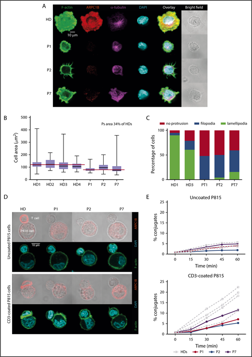 Figure 3. Defective assembly of the IS in ARPC1B-deficient T lymphocytes. (A) Confocal images of T cells from a HC and P1, P2, and P7 adhering to ICAM1/anti-CD3 Ab-coated slides and stained for F-actin, ARPC1B, α-tubulin, and DAPI. Images representative from 1 out of 3 experiments. (B) Quantification of the area of individual cells interacting with ICAM1/anti-CD3 Ab. Median bar with minimum-maximum. Red lines: median average for HD and patients. %: Mean percentage of the medians between patients and HDs. Results of 2 independent experiments. (C) Distribution of T-cell morphologies according to the indicated subtypes: cell without protrusion, emission of filopodia, or assembly of a circular lamellipodia. (D) Representative confocal images of control T cells or T cells from P1, P2, and P7 upon interaction with P815 that have been precoated or not with anti-CD3 Ab. Fixed conjugates were stained for F-actin, ARPC1B, and DAPI. Representative images from 1 out of 2 experiments. (E) Quantification of the proportion of T cells engaged in conjugates with P815 targets precoated or not with anti-CD3 Ab. Conjugate formation was assessed at the indicated time points upon cell mixture. Results of 2 independent experiments.