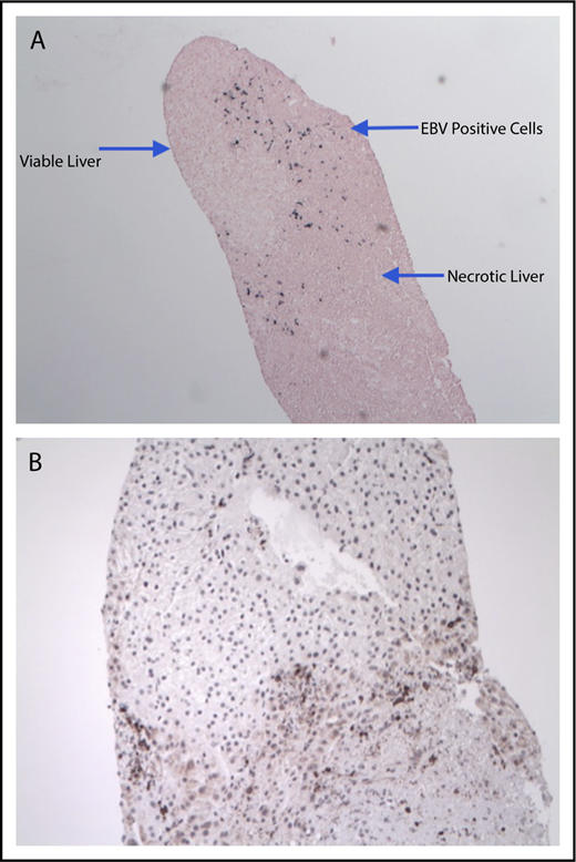 Figure 2. Hepatic necrosis in a patient after receiving LMP-T infusion. EBER in situ hybridization of liver biopsy showed EBV+ cells along the borders of necrotic hepatic tissue (original magnification ×4) (A), and CD3 immunohistochemical staining reveled numerous T lymphocytes in the same region (original magnification ×10) (B).