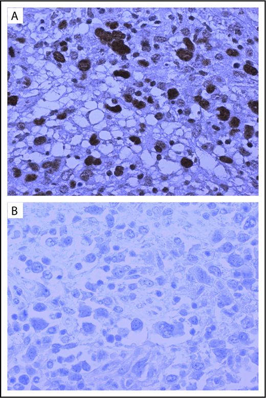Figure 6. Lymphoma relapse with loss of EBV positivity. (A) A patient who received LMP2-specific T cells as adjuvant therapy after undergoing allogeneic transplantation for an EBV+ HL, as demonstrated by positive LMP1 staining (×40), was noted to have progressive disease shortly after receiving LMP2-specific T cells. (B) However, biopsy of the relapsed lymphoma demonstrated that the tumor was no longer EBV+.