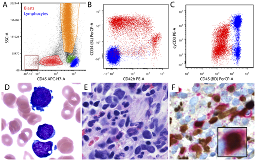 A newborn boy presented with leukocytosis (45 × 109/L), anemia (10 g/dL), and thrombocytopenia (12 × 109/L). Peripheral blood flow cytometry showed CD45 dim-to-negative blasts (panel A) positive for CD13, CD33 (subset), CD117, CD34, CD42b (panel B; >50% CD34-positive blasts express CD42b), CD41, and cyCD3 (panel C), while negative for CD1a, CD2, sCD3, CD4, CD5, CD7, CD8, CD19, and cyMPO. Bone marrow examination identified a dimorphic blast population (28%) with megakaryoblast and lymphoblast features (panel D; aspirate smear, Wright-Giemsa stain, original magnification ×1000) and fibrosis (panel E; core biopsy, hematoxylin and eosin stain, original magnification ×600). An immunohistochemical double-stain for GATA1 (brown) and CD3 (magenta) showed numerous biphenotypic blasts with megakaryocytic/T-lymphoid differentiation (panel F; original magnification ×600, inset ×1000). The conventional cytogenetic karyotype was 46,XY. Next-generation sequencing identified a novel CBFA2T3-GLIS3 fusion. He underwent acute lymphoblastic leukemia–directed induction therapy and allogeneic stem cell transplantation but relapsed with pure acute megakaryoblastic leukemia (cyCD3 negative), which was refractory to subsequent treatments. / Mixed-phenotype acute leukemia, T/megakaryoblastic, is exceptionally rare. The case presented here satisfies the criteria for both T-lineage assignment (cyCD3 intensity reaches that of normal T-lymphocytes) and acute megakaryoblastic leukemia (≥1 megakaryocytic marker in >50% blasts) and thus represents one of the first documented examples of this unusual entity.