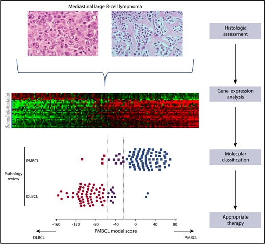 Use of a gene expression-based assay in the molecular classification of large B-cell lymphoma in the mediastinum into PMBCL and DLBCL.