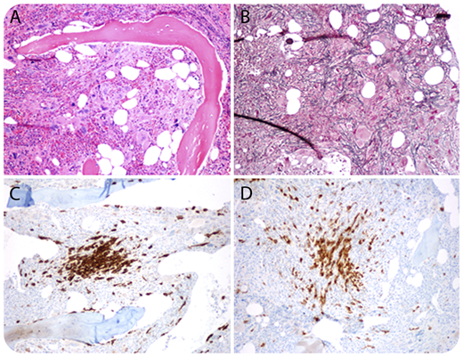 A 62-year-old woman was investigated for myeloproliferative neoplasm with splenomegaly. Complete blood count showed the following: hemoglobin, 123 g/L; leukocytes, 30.7 × 109/L; platelets, 273 × 109/L; myelocytes, 1.14 × 109/L; neutrophils, 23.72 × 109/L; eosinophils, 0.43 × 109/L; and basophils, 1.02 × 109/L. She had no skin lesions/lymphadenopathy, but lactate dehydrogenase was elevated (416 U/L). Peripheral blood (PB) showed a leukoerythroblastosis with teardrops and rare blasts. Aspirate was unsuccessful. Biopsy was hypercellular with megakaryocytic hyperplasia and atypia (panel A; original magnification ×40, hematoxylin and eosin stain) and focally increased eosinophils and MF-3 fibrosis (panel B; original magnification ×40, reticulin stain). CD34 showed <1% blasts. CD117 highlighted multifocal infiltrates of spindle-shaped/atypical mast cells (≥15) in aggregates (panel C; original magnification ×40) with positive tryptase/CD25 (panel D; original magnification ×40). JAK2 was positive and c-Kit on PB and BCR-ABL was negative. These findings fulfilled the major and 2 minor criteria for systemic mastocytosis (SM) and the 3 major and 4 minor criteria for overt primary myelofibrosis (PMF). The diagnosis was consistent with SM with an associated hematological neoplasm (SM-AHN) per 2016 World Health Organization criteria. / Compared with other SM-AHN, SM with associated PMF is relatively rare, likely because it can be easily missed as a result of dry tap and fibrosis. The case highlights the importance of careful inspection of biopsy and applying CD117 staining initially to unfold the disguised SM-AHN.