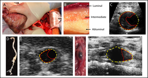 Figure 1. Composition of the ILT in humans and mouse models. (A) Representative picture of a 4.6-cm-diameter ILT (42.9 cm2) being removed from a 6-cm diameter aneurysm (79.4 cm2) during an open surgical procedure. (B) Macroscopic view of an ILT demonstrating the luminal, intermediate, and abluminal layers. (C) Ultrasound image of a human AAA with yellow and red dashed lines outlining the area of the aneurysm and thrombus, respectively. (D) A representative suprarenal AAA aorta from a low-density lipoprotein receptor–deficient (Ldlr−/−) mouse infused with AngII (1000 ng/kg per min) with an (E) in vivo ultrasound image captured at the maximum diameter on a Vevo 2100 (FUJIFILM VisualSonics Inc), where yellow dashed lines represent the area of the aneurysm and red dashed lines outline the extraluminal thrombus. (F) A representative infrarenal AAA aorta from a C57BL/6J mouse treated with topical elastase to induced aneurysm and administration of β3-aminopropionitrile fumarate salt (BAPN) ad libitum via water bottle to induce an ILT.45 (G) In vivo ultrasound of the topical elastase/BAPN model at the point of maximal expansion, where yellow dashed lines represent the area of the AAA and the red dashed lines outline the ILT.