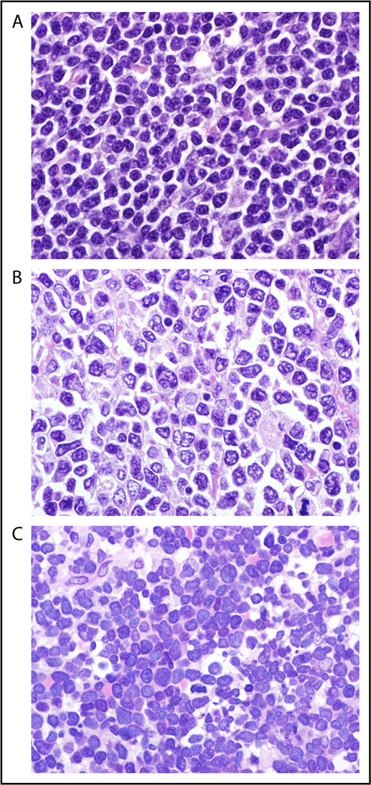 Figure 1. Cytology of mantle cell lymphoma classical (A), pleomorphic (B), and blastoid (C) MCL (original magnification ×1000, hematoxylin and eosin stain).