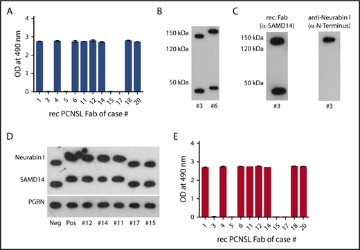 Figure 1. SAMD14 and neurabin-I as target antigen of recombinant PCNSL-derived BCRs. (A) ELISA of SAMD14 reactivity of PCNSL-derived recombinant BCRs. The columns represent adsorbence at OD 490 nm. (B) Western blots of PCNSL tissue lysates using SAMD14-specific recombinant BCR. Lane 1: PCNSL tissue from patient #3 with a BCR not reacting with SAMD14. Lane 2: PCNSL tissue from patient #6 with SAMD14 reactive BCR. Two proteins, one at 150 kDa (above) and at 45 kDa (bottom) of PCNSL, are targeted by the recombinant PCNSL-derived BCR, with both antigens from patient #6 having a higher molecular weight compared to the antigens from patient #3. (C) Identification of neurabin-I as the second antigen. Western blot of PNCSL tissue from patient #3. Lane 1: the SAMD14-specific recombinant PCNSL-derived BCR targets proteins at 145 kDa and 45 kDa; lane 2: stripped western blot for reprobing with a commercial antibody directed against the N terminus of neurabin-I, identified the 145 kDa band as neurabin-I. (D) Second isoform of SAMD14/neurabin-I in patients with SAMD14/neurabin-I-reactive lymphoma BCR. Western blots of PNCSL tissues from patients with SAMD-14/neurabin-I-specific lymphoma cell BCRs (lanes 2, 3, 4, and 5) showed a higher molecular weight than from patients with BCR specificities other than SAMD-14/neurabin-I (lanes 1, 6, and 7), whereas bands for progranulin were not different. (E) ELISA for neurabin-I reactivity of individual PCNSL-derived recombinant BCRs. The columns represent adsorbence at OD 490 nm, consistent with reactivity of the respective recombinant BCRs against neurabin-I.