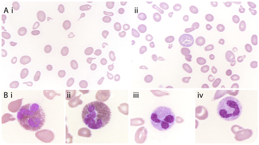 A 51-year-old Malian man with no remarkable medical history presenting with pancytopenia was referred to our department as a suspected case of acute leukemia. His leukocyte count was 2.8 × 109/L with 0.4 × 109/L neutrophils; platelets were 41 × 109/L. His hemoglobin level was 4.8 g/dL with low reticulocyte count. The diagnosis of vitamin deficiency was not the foremost hypothesis because a very mild macrocytosis (101 fL) was measured, yet with a high anisocytosis (red cell distribution width at 41%; normal value, <15%). The examination of the peripheral blood smear confirmed the heterogeneity of the red cell size, with macrocytes, macroovalocytes, and numerous schistocytes (panels Ai-ii; original magnification ×630, May-Grünwald Giemsa stain). Interestingly, neutrophil nuclei were normal, whereas the rare eosinophils observed displayed 3 to 4 lobes (panels Bi-iv; original magnification ×1000, May-Grünwald Giemsa stain), strongly suggesting the diagnosis of vitamin deficiency. This latter was confirmed by a low vitamin B12 level of 56 ng/L (normal values, 250-550 ng/L), which turned out to be related to a pernicious anemia. / Most hematologists are aware of the relevance of hypersegmented neutrophil nuclei for vitamin deficiency diagnosis. However, the level of hypersegmentation is not related to the depth of the deficiency, as illustrated here. This case highlights the relevance of careful blood smear examination, looking for hypersegmentation even in eosinophils, which can avoid costly investigation for exploration of unexplained hemolytic anemia.