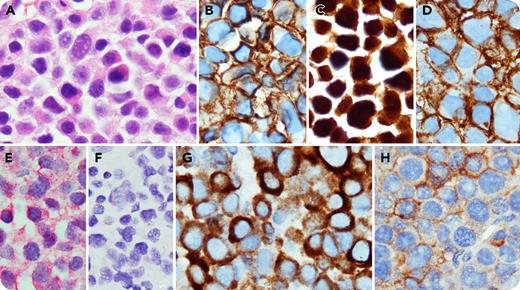 A 76-year-old woman presented with a lytic lesion involving the right ilium. A targeted biopsy showed diffuse infiltrate of atypical, pleomorphic plasma cells (panel A; original magnification ×1000, hematoxylin and eosin stain), positive for CD138 (panel B; original magnification ×1000), MUM1 (panel C; original magnification ×1000), CD56 (panel D; original magnification ×1000), cyclin D1 and λ (panel E; original magnification ×1000), and negative for CD19, CD20, CD117, κ (panel F; original magnification ×1000), and Epstein-Barr virus (EBV). The findings were diagnostic of a plasma cell neoplasm (PCN). Interestingly, the neoplastic cells showed strong cytoplasmic CD3ε (specific for the ε-chain of the human CD3) and dim CD4 expression (panels G-H; original magnification ×1000). Flow cytometry failed to detect the plasma cells. No other T-cell markers (CD2, CD5, CD7, or CD8) were detected. Serum and urine electrophoresis detected monoclonal immunoglobulin G-λ protein. The bone marrow showed no evidence of a PCN. / Aberrant T-cell antigen expression can be seen in various types of B-cell lymphoma. PCN can show aberrant antigen expression of different lineages, but expression of T-cell–related antigens, particularly dual CD3 and CD4, is exceedingly rare. Multiple theories have been proposed to explain the pathobiology of this phenomemon, including EBV infection, lineage infidelity, and Pax5 downregulation; however, the exact mechanism and clinical significance are still unclear. Nevertheless, this case emphasizes the importance of recognizing atypical and variable immunophenotypic aberrancies in PCN, which potentially could lead to diagnostic pitfalls.