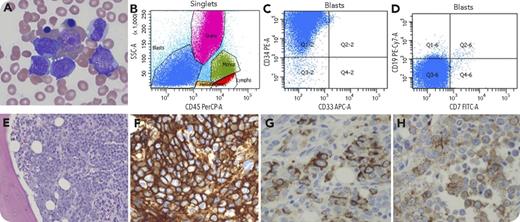 A 17-year-old boy presented with cough, chest pain for 3 weeks, and weight loss for several months. He was treated with multiple rounds of antibiotics with no improvement. A right lower lobe lung lesion with extension into the mediastinum and innumerable bone metastases were found by computed tomography and positron emission tomography scan. Bone marrow (BM) aspirate smear showed frequent medium- to large-sized mononuclear cells with blast morphology (panel A; Wright-Giemsa stain, original magnification ×1000). Flow cytometry of BM aspirate showed a CD45-negative abnormal cell population (in blue) strongly positive for CD34 and negative for myeloid or lymphoid markers (panels B-D). BM biopsy sections showed diffuse infiltrate by abnormal mononuclear cells (panel E; hematoxylin and eosin stain, original magnification ×200). The abnormal cells were strongly positive for CD34 (panel F; original magnification ×400) and focally positive for cytokeratin CAM5.2 and epithelial membrane antigen (panels G and H; original magnification ×400). Fluorescence in situ hybridization analysis showed NUTM1 (15q14) rearrangement. NUT midline carcinoma (NMC) was diagnosed. The patient had a brief response to the Scandinavian Sarcoma Group (SSG IX) protocol and died approximately 5 months after initial presentation. / NMC is a rare, very aggressive, poorly differentiated tumor that commonly affects mediastinum, head/neck, or other organs of the midline region. It can express CD34. Without cytogenetic study or immunostaining for NUT protein, the diagnosis is often difficult. When it diffusely infiltrates BM, it may mimic acute undifferentiated leukemia.