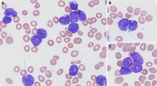 A 7-year-old previously healthy girl presented with fever, fatigue, and weight loss for 1 month. Laboratory test revealed normocytic anemia (hemoglobin, 7.1 g/dL), neutropenia (0.17 × 109/L), and 30% small- to medium-sized blasts with frequent (20%) cuplike nuclei (panels A-C, arrows; Wright’s stain, original magnification ×1000) in peripheral blood. Flow cytometry analysis revealed CD19+CD10+CD34+TDT+ blast population consistent with precursor B-cell acute lymphoblastic leukemia (B-ALL). Conventional cytogenetic study revealed a normal karyotype. Fluorescence in situ hybridization analysis revealed IKZF1 deletion. Microarray confirmed IKZF1 loss as the only cytogenetic aberration. She was started with induction chemotherapy per AALL0932 as standard risk B-ALL. At the end of induction, bone marrow showed 0.05% minimal residual disease by flow cytometry. Then her treatment was intensified to high risk protocol (AALL1131). She achieved complete remission after intensification chemotherapy. / Cuplike nuclear morphology is well recognized in acute myeloid leukemia and is frequently associated with a normal karyotype, as well as FLT3-ITD and/or NPM1 mutations. Cuplike nuclear morphology is uncommon in ALL, with only rare cases reported, including one Philadelphia chromosome–positive B-ALL and one B-ALL with TP53 and DNMT3A mutations. Its clinical significance and association with cytogenetic/molecular abnormalities in ALL are unknown.