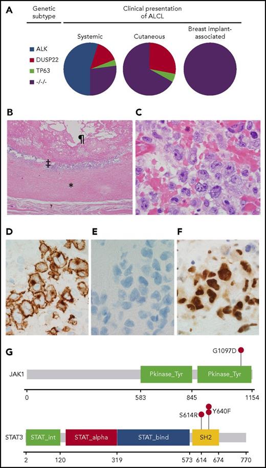 Figure 1. Pathological and genetic findings in BIA-ALCL. (A) Distribution of genetic subtypes in systemic, cutaneous, and breast implant–associated ALCL. −/−/−, triple-negative. (B) Low-power hematoxylin and eosin–stained image of a capsulectomy specimen showing the fibrous capsule (*), an inner layer of lymphoma cells (‡), and the original location of the implant and surrounding effusion (¶). Image was taken using an Olympus DP71 camera, Olympus BX51 microscope, and Olympus cellSens image acquisition software (original magnification ×40). (C) High-power hematoxylin and eosin–stained image of the capsule shows a cluster of large pleomorphic cells (original magnification ×1000). (D) Immunohistochemistry for CD30 shows strong and uniform staining in the neoplastic cells (original magnification ×1000). (E) Immunohistochemistry for ALK shows absence of staining in the neoplastic cells (original magnification ×1000). (F) Immunohistochemistry for pSTAT3Y705 shows strong nuclear staining in the neoplastic cells (original magnification ×1000). (G) Mutations in JAK1 and STAT3 in BIA-ALCL. Pkinase_Tyr, protein tyrosine kinase domain; SH2, Src homology 2 domain; STAT_alpha, all-α domain; STAT_bind, DNA binding domain; STAT_int, protein interaction domain.