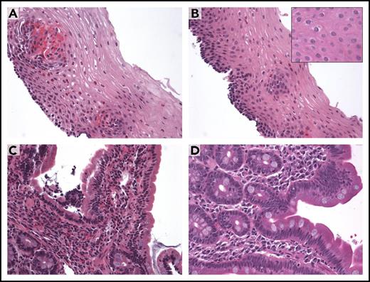 Figure 3. Histologic evidence of resolved eosinophilic esophagitis and duodenitis after dexpramipexole treatment. (A-D) Representative photomicrographs of the proximal esophagus (A-B) and duodenum (C-D), before treatment and at week 20 on dexpramipexole. (A) Squamous mucosa with active esophagitis and increased eosinophils (up to 20 per high-power field). (C) Duodenal mucosa with focally increased numbers of eosinophils (up to 100 per high-power field) and mild duodenitis. (B,D) At week 20 (on dexpramipexole), the squamous esophageal mucosa and the duodenal specimen demonstrate absence of eosinophilic infiltrates and normalization of tissue architecture. Esophageal mucosa at original magnification ×40 (B, inset) also shows lack of eosinophilic infiltrates. Images were acquired with a Nikon Eclipse 50i microscope equipped with an Olympus DP71 camera and software. Final image preparation was performed with Adobe Photoshop CS3 extended Version 10.0.1. Original magnifications: panel A, ×20/0.2 numerical aperture (NA); panel B, ×20/0.95 NA (inset, ×40); panel C, ×40/0.45 NA; panel D, ×40/1.40 NA. All panels, hematoxylin and eosin stain.