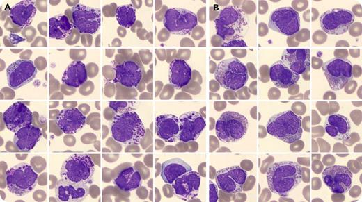 A 35-year-old man with a history of ankylosing spondylitis for which he received adalimumab was referred to our clinic because of marked leukocytosis detected from a routine blood test. He experienced occasional night sweats. He was found to have splenomegaly. The complete blood count showed normocytic anemia (13.37 g/dL, 90 fL), normal platelets (315 × 109/L), and leukocytosis (32.8 × 109/L) with basophilia (51%), eosinophilia (20%), promyelocytes (1%), and blasts (1%). Peripheral blood smear revealed prominent basophilia and atypical eosinophilia (panel A, atypical basophilic granulocytes; panel B, atypical eosinophilic granulocytes, with clearly visible cytoplasm, prominent nuclei, and an increased nuclear-cytoplasmic ratio; original magnification ×100, May-Grünwald Giemsa stain). Immunophenotyping showed a cell population negative for CD117, CD2, and CD25. Bone marrow biopsy showed increased cellularity with <10% myeloblasts as well as marked reticulin fibrosis. BCR-ABL1 fusion was negative. Conventional cytogenetics with gene-specific probes showed an extremely rare t(9;12)(q34;p13) resulting in the ETV6-ABL1 fusion. No additional cytogenetic abnormalities were observed, including no PDGFRa rearrangements. / The ETV6-ABL1 fusion induces a chronic myeloid leukemia–like disease with a more aggressive behavior and prominent basophilia. The patient received dasatinib with complete molecular response followed by an allogeneic transplantation.