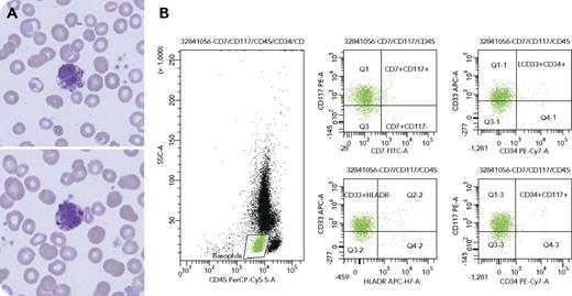A 74-year-old man was admitted following a syncopal episode and was incidentally found to have leukocytosis with basophilia. A peripheral smear evaluation revealed basophils with atypical nuclear lobation and decreased granularity (panel A; modified Wright's stain, original magnification ×100). A bone marrow biopsy revealed a hypercellular, myeloid-predominant marrow with megakaryocyte clustering and dysplasia but no increase in blasts. Flow cytometry of both the blood and marrow revealed an increased population of CD45mod+, atypical-immunophenotype basophils that were dimly positive for CD33 (atypically decreased) and CD117 (atypically increased) and negative for CD34 (panel B). Molecular studies were notable for a JAK2 V617F mutation and negative for BCR-ABL. Next-generation sequencing identified oncogenic variants in IDH2, SRSF2, and ASXL1. Karyotype was normal, as were fluorescence in situ hybridization studies. The patient was ultimately diagnosed with a myelodysplastic/myeloproliferative neoplasm. / This case is an illustrative example of atypical basophilia in myeloid neoplasms. Classically, chronic myeloid leukemia with t(9;22) presents with basophilia; notably, however, it can be seen in other myeloproliferative and myelodysplastic/myeloproliferative neoplasms. Normal basophils have segmented nuclei (often obscured by coarse basophilic granules) and are CD45mod+/CD34−/CD33+/CD117−/CD38++/HLA-DR−/CD64−/CD123++. It has been shown that in myeloid neoplasms, basophils are increased and often have decreased CD38 expression and variable expression of CD34/HLA-DR/CD117/CD64/CD123, which can be easily mistaken for blasts.