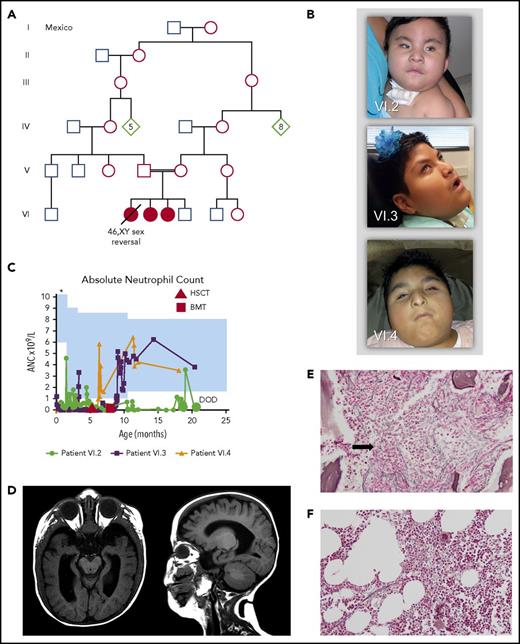 Figure 1. Family pedigree and phenotypic features of the patients. (A) Family pedigree indicating consanguinity. Filled symbols represent affected individuals (patients VI.2, VI.3, VI.4). (B) Photographs of patient VI.2 at 11 months, patient VI.3 at 9 years 2 months, and patient VI.4 at 4 years 11 months. Note microphthalmia, beaked nose, and prominent columella. Consent for the publication of images was provided by the patients’ parents. (C) Absolute neutrophil count (ANC) over time for the 3 patients. Shaded blue area represents the normal reference range based on age. The upper limit of normal in the newborn period in our laboratory is 23.5 × 109/L, which is above the range depicted (*). (D) Brain magnetic resonance imaging of patient VI.3 at age 9 months. Note supratentorial volume loss involving the white matter more than the gray matter, ex vacuo ventricular enlargement, and optic nerve hypoplasia. (E) Bone marrow biopsy for patient VI.3 at age 33 days. Reticulin stain, original magnification ×200. Note moderate to severe reticulin fibrosis. Trichrome staining for collagen fibers was not performed. (F) Bone marrow biopsy for patient VI.3 at age 20 months, 1 year after bone marrow transplantation. Reticulin stain, original magnification ×200. Note the reduction in reticulin fibrosis to mild and focal. Trichrome staining for collagen fibers was negative (data not shown). BMT, bone marrow transplantation; DOD, date of death; HSCT, hematopoietic stem cell transplantation.