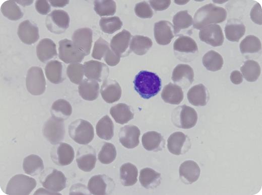A 50-year-old African American man with no known medical history presented with shortness of breath and leukocytosis. Biopsy specimens of an anterior mediastinal mass showed T-lymphoblastic leukemia/lymphoma. Rasburicase was administered for tumor lysis syndrome, leading to hypoxia, hyperkalemia, and methemoglobinemia within 24 hours. Review of a peripheral smear showed findings consistent with hemolysis, with erythrocyte changes including near-diffuse bite cells, helmet cells, blister cells, and frequent nucleated red blood cells (Wright Giemsa stain, original magnification ×1000). A methylene blue–stained peripheral blood smear showed Heinz bodies. Methylene blue was administered without significant improvement. Subsequent testing for glucose-6-phosphate dehydrogenase deficiency (G6PD) upon resolution confirmed enzyme deficiency. / Patients with G6PD deficiency are unable to convert glucose-6-phosphate into 6-phosphogluconolactone. The resultant accumulation of reactive oxygen species within erythrocytes leads to oxidation of hemoglobin (methemoglobin) and accumulation of denatured hemoglobin, which can result in hemolytic anemia, reduced arterial oxygen saturation on pulse oximetry, and impaired oxygen delivery to tissues from methemoglobin, often necessitating supplemental oxygen. Although G6PD testing is recommended prior to rasburicase administration, it is often not practical because of disease acuity. However, if feasible, testing for G6PD deficiency in patients of high-prevalence ethnicities should be considered before administration of this medication and methylene blue administration avoided.
