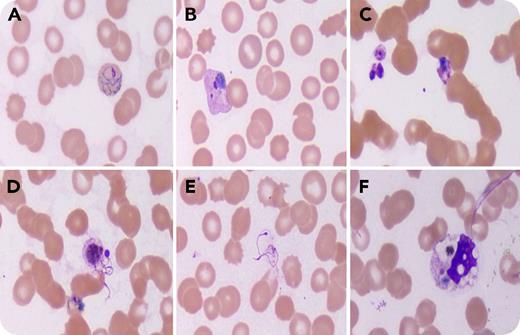 A 23-year-old woman presented with moderate- to high-grade fever for 2 days, multiple episodes of vomiting, and per vaginal bleeding. Physical examination revealed pallor and icterus. There was no organomegaly or lymphadenopathy. Her complete blood count showed anemia (9.1 g/dL) and thrombocytopenia (50 × 103/μL). The peripheral blood film revealed intraerythrocytic Plasmodium vivax forms (panels A-B; original magnification ×1000; Leishman stain). In addition, exflagellation of microgametocytes was noted at different stages (panels C-E; original magnification ×1000; Leishman stain). Also, occasional neutrophils and monocytes showed intracytoplasmic remnants of engulfed parasitic pigment (panel F; original magnification ×1000; Leishman stain). The species identification was also confirmed by using a rapid diagnostic test (SureTest Malaria PF/PV HRP2/pLDH Combo test). In the life cycle of a malaria parasite, the exflagellation of microgametocytes occurs in the stomach of the Anopheles mosquito. One male gametocyte can release up to 8 thin and long microgametes. / Rarely, exflagellation has been reported in the peripheral blood of humans, and the presence of exflagellation might create confusion during diagnosis. The presence of other forms of the parasite and the fact that exflagellation can occur in peripheral blood in P vivax infection will help in arriving at the correct diagnosis.
