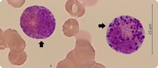 A 66-year-old man was referred to our hospital for fatigue and pancytopenia. His hemoglobin level was 7.4 g/dL, with a white cell count of 2.6 × 109/L and platelet count of 39 × 109/L. To evaluate his pancytopenia, a bone marrow examination was performed. May-Giemsa staining of bone marrow aspiration showed 6% blasts and dysplastic eosinophils with large purple-violet granules resembling basophilic granules (arrows). Dysplastic eosinophils with metachromatic granules are often referred to as harlequin cells, which are commonly observed in acute myeloid leukemia (AML) with inv(16)(p13.1q22) or t(16;16)(p13.1;q22) and chronic myeloid leukemia. / A conventional cytogenetic analysis of his excess blasts revealed an inversion of chromosome 16. Moreover, the detection of CBFB-MYH11 fusion transcripts using reverse transcription polymerase chain reaction confirmed the diagnosis of AML with inv(16)(p13.1q22). In the World Health Organization classification, neoplasms with the following specific recurrent cytogenetic abnormalities are regarded as acute leukemias, irrespective of the blast percentages: t(8;21)(q22;q22.1), inv(16)(p13.1q22) or t(16;16)(p13.1;q22), and t(15;17)(q24.1;q21.2). After chemotherapy with cytarabine and anthracyclines, the patient’s pancytopenia and dysplastic eosinophils resolved. He remains in remission 6 months later. Harlequin cells imply a myeloid neoplasm regardless of the blast percentage.