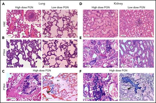 Figure 6. PGN challenge induces peripheral organ congestion and fibrin deposition. Pathologic changes in peripheral tissues at end point were evaluated after histologic staining with H&E (top) or PTAH (middle and bottom) for detection of fibrin deposits. Images were acquired on an upright Nikon Eclipse E800M microscope equipped with an Omax high-speed digital camera using the Omax ToupView software. Representative lung and kidney micrographs from PGN-challenged baboons are shown. (A-C) Pulmonary pathologic changes are more prominent in the high-dose (left panel) than low-dose group (right panel). Liquid-filled (*) alveoli (av) and fibrin deposits (arrows) are highlighted throughout the figure. An example of leukocyte aggregates obstructing the pulmonary microvasculature in the high-dose PGN challenge is depicted in the left panel inset in panel A. Intravascular (left panel) and extravascular (right panel) fibrin deposits are easier identified at higher magnification in panel C. (D-F) Renal pathology is more prominent in the high-dose PGN challenge (left panels) than the low-dose group (right panels). Glomeruli (G) and tubules (T) are exemplified throughout the figure. Fibrin deposition (arrows) in either tubular (left) or glomerular (G) areas is highlighted at higher magnification in panel F. Scale bars represent 100 µm.