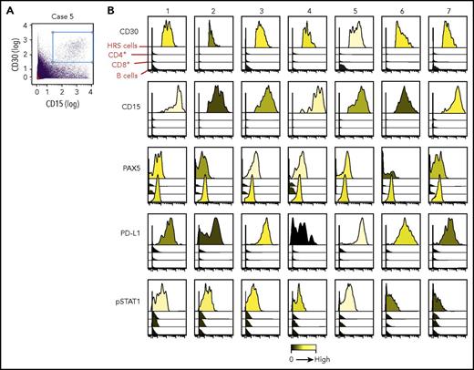 Figure 2. Identification and characterization of HRS cells. (A) A representative cHL with CD15+/CD30+ HRS cells identified by manual gating. (B) HRS cells from each analyzed primary cHL (1-7). HRS cells express CD15+ and CD30+. CD4+ T cells, CD8+ T cells, or B cells from the same primary cHL samples lack CD15+ and CD30+ expression. PAX5+ is expressed by HRS cells and B cells. PD-L1 and pSTAT1 are expressed by HRS cells from all examined cHLs. These markers are absent or reduced in the other cell subsets.