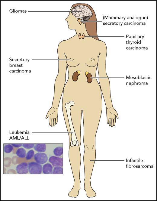 A schematic presentation of the different types of cancers reported to harbor the ETV6-NTRK fusion gene. Other NTRK fusion translocations have been rarely reported in many diverse cancers including soft tissue sarcomas, lung colon and pancreatic cancers, cholangiocarcinomas, and more. AML, acute myeloid leukemia.