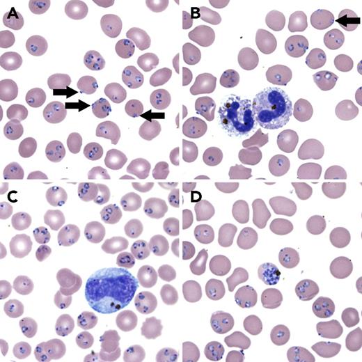 A 27-year-old man developed high fever after returning from sub-Saharan Africa. Trying to overcome this febrile illness during his annual leave (winter season), he had medical home visits, but the fever was repeatedly misdiagnosed as a flulike illness and treated with paracetamol (acetaminophen) only. He eventually collapsed and was brought to hospital with a reduced level of consciousness. The peripheral blood smear confirmed Plasmodium falciparum malaria based on typical morphological changes. Infected red blood cells (RBCs) were normal in size and contained young ring-forms of the same maturation stage, showing occasional accollé/appliqué forms (panel A, arrows; Leishman stain, original magnification ×1000). Contrary to the other species, P falciparum infects RBCs of all ages, which explains the severe hyperparasitemia (44.6%) observed in this case (threshold for severe malaria: >5%). The high number of hemozoin-containing polymorphonuclear leukocytes (25%) (panel B; Leishman stain, original magnification ×1000) was another laboratory indicator of severity (threshold: >5%). Pigmented monocytes were also present (panel C; Leishman stain, original magnification ×1000). Mature pigmented parasites (panel D; Leishman stain, original magnification ×1000) are also a criterion for severity (threshold: >20% of parasites). Unusual is the marked multiparasitism (22%, 1 parasite/RBC; 12%, 2 parasites/RBC; 7%, 3 parasites/RBC; 3.5%, 4 or more parasites/RBC). Theoretically, 80% of all RBCs could have been infected by a single parasite each. / Always consider malaria after a patient has returned from an area where malaria is endemic.