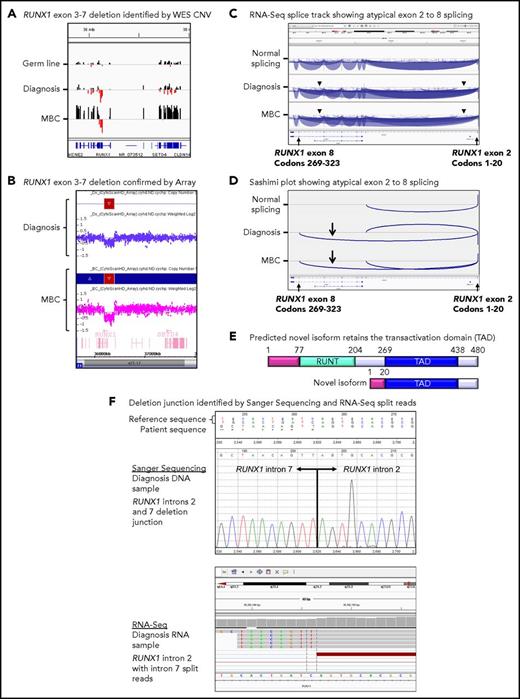 Figure 4. Somatic RUNX1 deletion and novel transcript. (A) CNV BedGraphs were generated by an in-house algorithm from the WES data for the germ line, diagnosis, and MBC samples of patient 3. The germ line gray central horizontal line indicates 2 copies of each gene. Extended red bars below the central line indicate a deletion of RUNX1 exons 3 to 7 at diagnosis and MBC. The extended black bars above the central line at MBC indicate chromosome 21 gain. (B) The RUNX1 deletion was confirmed by the CytoScan HD Array, where additional intronic markers revealed the full extent of the deletion. The genomic region is shown using the Affymetrix Chromosome Analysis Suite for the diagnosis and MBC samples. Red boxes represent the deletion, and blue boxes at MBC confirm the gain. (C) The deletion generated a novel in-frame RUNX1 exon 2 to 8 transcript. The splice junction tracks visualized in the Integrative Genomics Viewer are shown for a representative sample analyzed by RNA-Seq with normal RUNX1 splicing and the diagnosis and MBC samples of patient 3 with atypical RUNX1 exon 2 to 8 splicing. Arcs represent splice junctions that connect exons. Junctions from the minus strand are colored blue and extend below the center line. The arrowheads indicate the location of the genomic deletion breakpoints. RefSeq transcripts are shown at the bottom. (D) Sashimi plots of the diagnosis and MBC samples generated from the RUNX1 RNA-Seq splice junction track, which allows visualization of the novel splice generated by the deletion. Only the junctions that overlap RUNX1 RefSeq transcript ID NM_001754 exon 2 are shown. (E) The predicted novel isoform excludes the Runt DNA binding domain. (F) The stranded RNA-Seq protocol enabled sequencing of intron-retaining precursor RNA and genomic breakpoint detection. The intronic breakpoints were identified by RNA-Seq of the corresponding RNA samples at chr21:36392146 in intron 2 and chr21:36201259 in intron 7 (hg19). The genomic deletion junction was polymerase chain reaction amplified and Sanger sequenced, which confirmed a 190 888 base deletion.