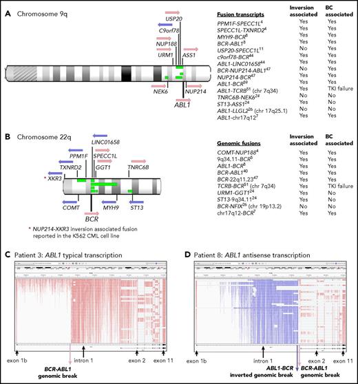 Figure 5. Ph translocation–associated fusions and rearrangement. Chromosomes 9q (A) and 22q (B) are shown along with the location of genes involved in the fusions. Pink arrows indicate transcription from the plus strand and blue arrows from the minus strand. Green bars indicate the relative location of deletions detected in 4 patients: patients 4, 8, 11, and 26. These align with the fusion partners in some cases. Sequence inversions brought some genes into the same transcriptional orientation. Fusion partners were located upstream and downstream of ABL1 and BCR, indicating the complex nature of the rearrangements. Fusion partners were also located on other chromosomes in 3 patients with variant Ph translocations. Listed are fusion transcripts and the genomic fusions where no corresponding fusion transcript was identified. Superscripts indicate the patient number. Two fusions involved intragenic sequence inversions: BCR sequence inversion (NUP214-BCR) and GGT1 sequence inversion (URM1-GGT1). Some fusions involving an intergenic sequence also contained an inverted sequence. (C) RNA-Seq aligned sequencing reads that mapped to the ABL1 gene for a representative patient at diagnosis (patient 3) viewed in the Integrative Genomics Viewer. Reads are colored by first-of-pair strand. A large number of reads were evident in intronic regions because the protocol sequenced total RNA, including intron-retaining primary RNA transcripts. ABL1 is transcribed on the plus strand, and reads are colored pink. (D) Patient 8 had a large ∼93-Kb inversion within ABL1 intron 1, as indicated by the reads colored blue, which specify antisense transcription. A genomic break was evident at the distal end of the antisense transcripts, which was an ABL1-BCR genomic fusion inversion. The BCR-ABL1 genomic breakpoint was located 224 bp upstream in the correct transcriptional orientation. The patient also had a 13-Mb deletion between BCR and the MYH9 gene on chromosome 22 (shown in panel B), plus an inversion that brought MYH9 into the same transcriptional orientation as BCR and generated an MYH9-BCR fusion transcript.