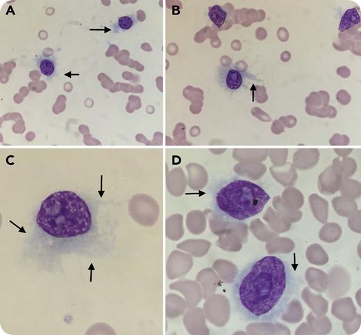 A 76-year-old woman presented with pallor, fatigability, and body ache. The complete blood count showed hemoglobin 6.7 g/dL, leukocytes 6.5 × 109/L, lymphocytes 5.1 × 109/L, and platelets 11 × 109/L. Peripheral blood smears revealed medium-to-large atypical lymphoid cells (82%) with hairy and shredded cytoplasmic projections (arrows) and dispersed chromatin with prominent nucleoli resembling variant hairy cell leukemia (vHCL) (panels A-D; May-Grünwald Giemsa stain, original magnification ×1000). On flow cytometry, the side scatter/CD19 gated cell cluster (78%) lacked expression of CD11c, CD23, CD103, or CD123 excluding vHCL but expressed CD38 (strong), CD138 and CD56 (coexpressed), and λ light-chain restriction. Serum protein electrophoresis and immunofixation revealed M-component immunoglobulin G λ. The overall features were consistent with plasma cell leukemia (PCL). / Plasma cells do occasionally show hairy and shredded cytoplasm, but they do not usually constitute the entire plasma cell population as in this case. However, the morphology of plasma cells is often misleading and is not the only diagnostic criterion for PCL. This case highlights the rationale of PCL being taken as a differential diagnosis when one sees typical morphology of vHCL. Inclusion of plasma cell markers in the immunophenotyping panel for B-cell lymphomas with vHCL morphology is thus recommended.