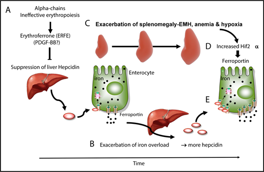 Figure 2. Causes and consequences of β-thalassemia. (A) During the early stages of BT, as well as in the absence of transfusion or when transfusion is inadequate, IE and erythroid expansion are responsible for hepcidin suppression, likely through erythroferrone. (B) This leads to increased iron absorption and iron overload. (C) Over time, splenomegaly occurs, exacerbating extramedullary erythropoiesis, RBC sequestration, anemia, and hypoxia. In particular, hypoxia stabilizes a transcription factor called HIF2α in enterocytes (D), which increases expression of ferroportin, among other iron-related molecules, in the duodenum (E). Therefore, the relative balance of hepcidin vs ferroportin is such that iron absorption is still increased, despite the fact that iron overload is promoting hepcidin expression.