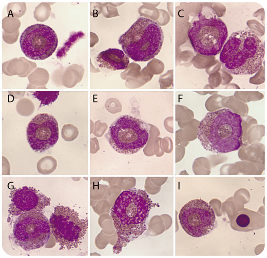 A 53-year-old morbidly obese woman diagnosed with Crohn disease 3 years earlier was being treated with adalimumab (40 mg per 15 days) and methotrexate (15 mg per week). She presented with severe fatigue and a 30-kg weight loss over the previous 2 months, as well as fever and multiple new-onset ulceronecrotic skin lesions on her lower limbs. Skin biopsy disclosed microvascular thrombosis and a prominent eosinophilic infiltrate in the dermis. On admission, severe pancytopenia was found: hemoglobin, 44 g/L; mean corpuscular volume, 100 fL; leukocytes, 0.58 × 109/L (eosinophils, 0.17 × 109/L); and platelets, 36 × 109/L. The bone marrow aspirate (BMA) was hypercellular with severe dyshemopoiesis, 0.5% granulopoiesis, and 31% eosinophils (confirmed by flow cytometry). Widespread dysplasia was observed in eosinophils, with 1.5% of eosinophils having ring-shaped nuclei as highlighted (BMA; panels A-I: original magnification ×1000, May-Grünwald-Giemsa stain) (courtesy of Ricardo Bernal, Seville, Spain). Finally, the patient’s pancytopenia recovered on discontinuing adalimumab and methotrexate. / Peripheral eosinophilia with an eosinophilic infiltrate affecting skin lesions has been described with anti–tumor necrosis factor α therapy such as adalimumab. This case illustrates a significant bone marrow eosinophilia and the unusual observation of ring-shaped nuclei in eosinophils. These anomalies may be associated with the administration of adalimumab or its combination with methotrexate.