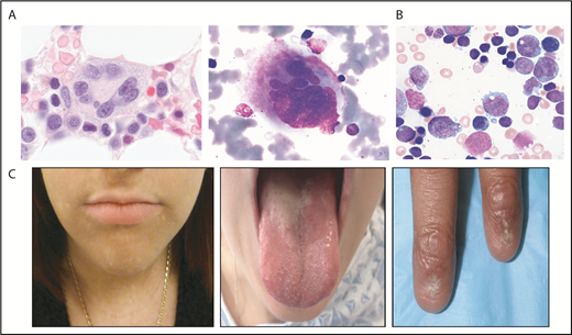 Figure 1. Selected bone marrow histology and physical findings associated with genetic MDS predisposition syndromes. (A) Hematoxylin and eosin (left panel) or May-Grunwald Giemsa staining of abnormal bone marrow megakaryocytes present in GATA2 predisposition disorders. (B) May-Grunwald Giemsa staining of bone marrow aspirate from a patient with SCN demonstrating myeloid maturation arrest (marrow images courtesy of M. Fleming). (C) Patient features characteristic of diagnostic triad of TBDs, including lacy/reticular pigmentation on neck and trunk, oral leukoplakia, and dystrophic fingernails (images courtesy of S. Agarwal).
