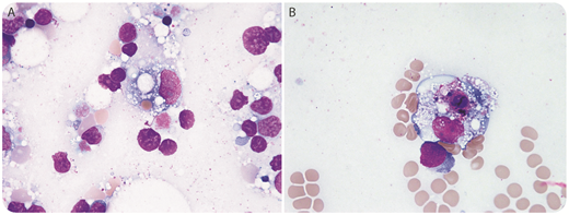 A 47-year-old man with refractory epilepsy was started on lamotrigine. A few days later, he presented to our hospital with a fever, diffuse rash, and splenomegaly. Laboratory tests revealed a transaminitis, leukopenia (1.6 × 109/L), and thrombocytopenia (77 × 109/L). During the initial evaluation, an infectious process, connective tissue disorder, and overt malignancy were ruled out. Given the reported association between lamotrigine and hemophagocytic lymphohistiocytosis (HLH) since at least 2007 and a recent US Food and Drug Administration warning about this serious adverse effect of lamotrigine, HLH was suspected. Ferritin and CD25 levels were requested. Both were found to be very elevated (35 335 ng/mL and 10 680 pg/mL, respectively). Based on the Treatment Protocol of Hemophagocytic Lymphohistiocytosis 2004 trial criteria, the clinical picture was consistent with HLH. A subsequent bone marrow biopsy supported the diagnosis by showing myeloid and megakaryotic hyperplasia and increased histiocytes showing hemophagocytosis (panels A and B, respectively; Wright-Giemsa stain, original magnification ×1000). Genetic testing for HLH revealed no germline mutations, deletions, or duplications. / Shortly after admission, lacosamide was substituted for lamotrigine and treatment with etoposide and dexamethasone was initiated. Soon after, the fever subsided and the rash resolved. Over the following weeks, ferritin declined and the cytopenias improved steadily until normalization of both. Hematologists should be aware of this potentially fatal complication with lamotrigine therapy.