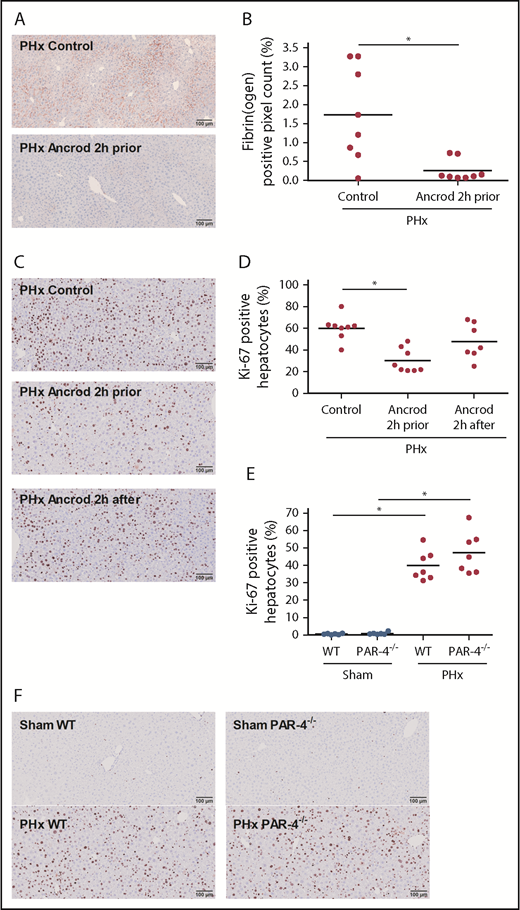 Figure 2. Effect of fibrinogen depletion and PAR-4 deficiency on liver regeneration after PHx. Mice were euthanized 30 minutes or 3 days after sham or PHx. (A) Representative images of fibrin(ogen) immunohistochemical staining 30 minutes after PHx in vehicle-treated (control, upper panel) and ancrod-treated (lower panel) mice. (B) Quantification of fibrin(ogen) deposition after PHx, expressed as positive pixel count (n = 8). (C) Representative images of Ki-67–stained livers 3 days after PHx for vehicle-treated mice (upper panel), mice receiving ancrod 2 hours before PHx (middle panel), and mice receiving ancrod 2 hours after PHx (lower panel). (D) Quantification of Ki-67–positive hepatocytes, expressed as percentage of total number of hepatocytes for control mice (n = 8), and mice treated with ancrod 2 hours prior (n = 8) or after (n = 7) PHx. (E) Quantification of Ki-67–positive hepatocytes, expressed as percentage of total number of hepatocytes for WT and PAR-4−/− mice (n = 6 for sham, n = 7 for PHx). (F) Representative images of Ki-67–stained livers for sham (upper panels) or PHx (lower panels) 3 days after surgery for WT and PAR-4−/− mice. Horizontal lines represent the mean; closed circles are individual mice. *P < .05.