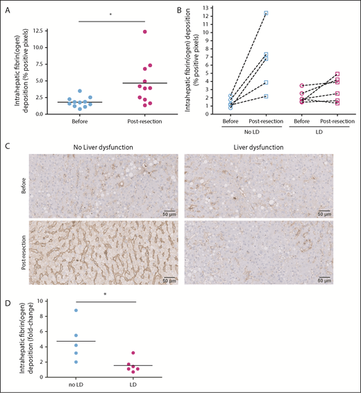 Figure 4. Lack of increase in intrahepatic fibrin(ogen) deposition after resection corresponds with LD following liver resection in humans. Liver biopsy specimens were obtained from 11 patients before resection (before) and 2 hours after ligation of the portal vein (postresection) and stained for fibrin(ogen). (A) Changes in intrahepatic fibrin(ogen) deposition before the surgery and postresection. (B) Individual changes in intrahepatic fibrin(ogen) deposition before (open circles) and post-resection (open squares) between patients who did (LD, n = 6) or did not (no LD, n = 5) suffer from postoperative LD. (C) Representative images of intrahepatic fibrin(ogen) immunohistochemical staining in liver biopsy specimens obtained before surgery (upper panels) or postresection (lower panels). Left panels show images of liver biopsy specimens taken from a patient who did not develop LD. Right panels show images of liver biopsy specimens taken from a patient who developed postresection LD. (D) The fold change (percent positive pixels postresection divided by percent positive pixels before) in intrahepatic fibrin(ogen) deposition in patients who did not develop LD (no LD) following PHx and patients who did (LD). Intrahepatic fibrin(ogen) deposition is expressed as percent positive pixels, and individual patients are plotted in panels A, B, and D. Dashed lines connect individual changes in intrahepatic fibrin(ogen) deposition before and after resection. *P < .05.