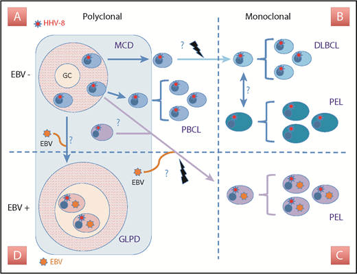 Figure 2. Spectrum of KSHV/HHV-8 LPDs according to clonality and EBV association. (A) MCD is characterized by KSHV/HHV-8+ EBV− polyclonal plasmablastic B cells; these cells may be the counterpart of naturally infected B cells that undergo proliferation and viral replication and expand within a specific context such as HIV infection or aging. In some cases, the rapid and aggressive development of a polyclonal B-cell lymphocytosis (PBCL) can mimic lymphoma with leukemic phase. (B) In rare cases, evolution toward frank monoclonal DLBCL may occur and may be difficult to distinguish from an EBV− PEL, notably in its solid/extracavitary form. (C) Classic PEL is usually associated with coinfection of the lymphomatous cells with EBV. These cells are clonal with complex karyotypes and exhibit somatic hypermutations, suggesting that they originate from GC/post-GC B cells; within an alternative scenario, they would originate from the same KSHV/HHV-8–infected plasmablasts seen in MCD lesions with subsequent clonal evolution toward a post-GC phenotype under the influence of EBV infection. (D) GLPD is characterized by the presence in the GC of large B cells coinfected with KSHV/HHV-8 and EBV without evidence of clonality.