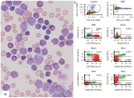 A 12-year-old girl had marked leukocytosis (white blood cell count, 692 000/µL), severe anemia (hemoglobin, 5.9 g/dL), and thrombocytopenia (platelet count, 13 000/µL). Peripheral blood (PB) and bone marrow (BM) smears appeared similar with numerous small to large blasts (panel A; Wright-Giemsa stain, original magnification ×1000). Flow cytometry detected 2 distinct populations: B lymphoblasts (PB, 93%; BM, 96%) and monoblasts (PB, 2.0%; BM, 3.0%). The lymphoblasts were positive for CD19, partial CD34, and CD15 and negative for CD10 and CD20 (panel B, red), a pattern frequently seen in B-cell acute lymphoblastic leukemia (ALL) with t(4;11) KMT2A-AFF1–rearranged. The monoblasts were intermediate to large, expressed heterogeneous CD11C, bright CD15, CD33, and CD64 and were negative for CD19, CD34, CD13, CD14, and CD117 (panel B, green). The patient was diagnosed as mixed-phenotype acute leukemia with t(4;11) KMT2A-AFF1–rearranged upon confirmation by karyotyping and fluorescence in situ hybridization (FISH) (91.3% in BM). Residual disease was detected by flow cytometry on day 29 in BM after ALL induction therapy (0.3% B lymphoblasts and 3.8% monoblasts) and on day 29 in BM after ALL consolidation therapy (0.17% B lymphoblasts and 4.7% monoblasts). FISH analysis detected KMT2A rearrangement in 4.8% cells in the BM after consolidation. / This case highlighted the power of flow cytometry in diagnosing leukemia. It illustrates the important point that small but significant abnormal populations can be obscured by large ones.