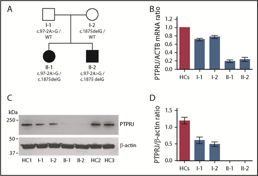 Figure 1. Compound heterozygosity for the variants identified in PTPRJ results in the almost complete loss of mRNA and protein. (A) Pedigree of the investigated family. Black symbols indicate thrombocytopenia. (B) PTPRJ mRNA expression in whole blood of the members of the family, as detected by real-time PCR. Expression is reported as fold change in PTPRJ relative to ACTB (β-actin) levels calculated with the ΔΔCt method. Data represent the means ± SD of 3 independent experiments using 3 HCs. (C-D) PTPRJ protein abundance in platelets from the members of the family. Lysates of washed platelets obtained from the 2 probands, their parents, and different HCs were analyzed by immunoblotting using an antibody against PTPRJ. β-actin was used as loading control. (C) Representative image of the immunoblotting experiments. (D) Densitometric analysis of the bands obtained in 3 independent experiments (means ± SD). PTPRJ level is expressed as the PTPRJ/β-actin ratio.