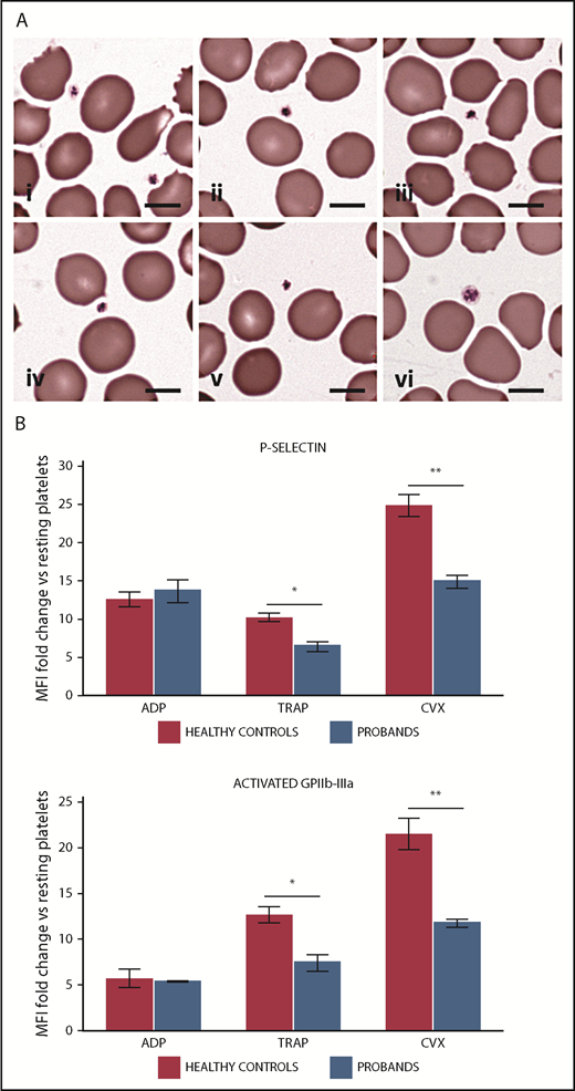 Figure 2. Patients with PTPRJ-null variants present platelets with small size and defective platelet response to convulxin and thrombin receptor activating peptide (TRAP). (A) Peripheral blood smears, May-Grünwald-Giemsa staining: representative examples of small-sized platelets from proband I-2 (i-iii) and proband II-2 (iv-v). The images are representative of the average platelet observable in patients’ blood smears. In (vi), an average platelet of normal size for a healthy subject is shown for comparison. Scale bars, 5 µm. (B) Flow cytometry of platelet activation in response to ADP, TRAP, and convulxin (CVX) in probands II-1 and II-2. Platelet surface expression of P-selectin and of the activated form of GPIIb-IIIa (PAC1 antibody binding) was measured after incubation with ADP (5 mM), TRAP (25 µM), CVX (100 ng/mL), or vehicle (HEPES buffer). Platelet activation is expressed as the ratio between mean fluoresce intensity (MFI) measured after stimulation with each agonist and MFI measured after incubation with the buffer alone (resting platelets). The values obtained in the 2 probands were aggregated and compared with those of 3 HCs processed in parallel. Data represent the mean ± SD of 2 independent analyses. *P < .05, **P < .01, 2-tailed Student t test.