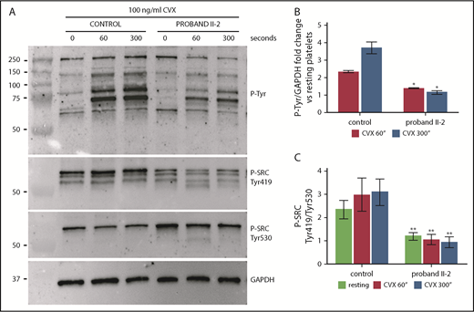 Figure 3. Platelets from proband II-2 show impaired tyrosine phosphorylation after stimulation with convulxin (CVX) and reduced activation of the SFK SRC. Platelets were obtained from peripheral blood from proband II-2 and HCs. Lysates were prepared with resting platelets (time 0 seconds) and after stimulation with 100 ng/mL CVX for 60 and 300 seconds. Immunoblotting was performed with the 4G10 anti-phosphotyrosine antibody (P-Tyr), with an antibody recognizing SRC phosphorylated at Tyr419 (SRC activation tyrosine) and with an antibody recognizing SRC phosphorylated at Tyr530 (SRC inhibitory tyrosine). GAPDH was used as loading control. (A) Representative image of the immunoblotting experiments. (B) Densitometric analysis of tyrosine phosphorylation. The bands obtained with 3 separate experiments (mean ± SD) were analyzed. Change in tyrosine phosphorylation after stimulation with CVX for 60 and 300 seconds is expressed as the fold increase in the P-tyrosine/GAPDH ratio with respect to the resting condition. The proband showed a marked inhibition of the increase in tyrosine phosphorylation of all detectable proteins in response to CVX at both time points. (C) Densitometric analysis of SRC phosphorylation. The bands obtained in 3 separate experiments (means ± SD) were analyzed. SRC activation status is expressed as the SRC phospho-Tyr419/SRC phospho-Tyr530 ratio normalized to GAPDH. The proband showed significantly reduced activation of SRC under resting conditions and after activation with CVX. *P < .05, **P < .01 vs HCs, 2-tailed Student t test.