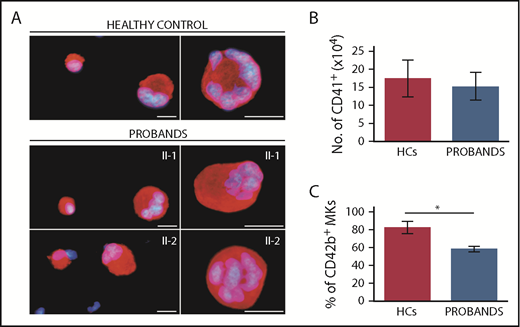Figure 4. Megakaryocytes (MKs) of the probands exhibit normal in vitro differentiation and defective terminal maturation. MKs were differentiated from peripheral blood progenitor cells through 14-day culture. Samples from probands II-1 and II-2 were processed in parallel with those of 3 HCs. (A) Representative images of MKs labeled with an anti–β1-tubulin antibody (red fluorescence). Hoechst (blue) was used for counterstaining nuclei. Scale bars, 25 µm. (B) MK differentiation was assessed as the yield (absolute number) of CD41+ cells at day 14 of culture, as measured by flow cytometry. (C) MK maturation was assessed as the percentage of CD41+ cells coexpressing the CD42b antigen, as measured by flow cytometry. *P < .001, 2-tailed Student t test.